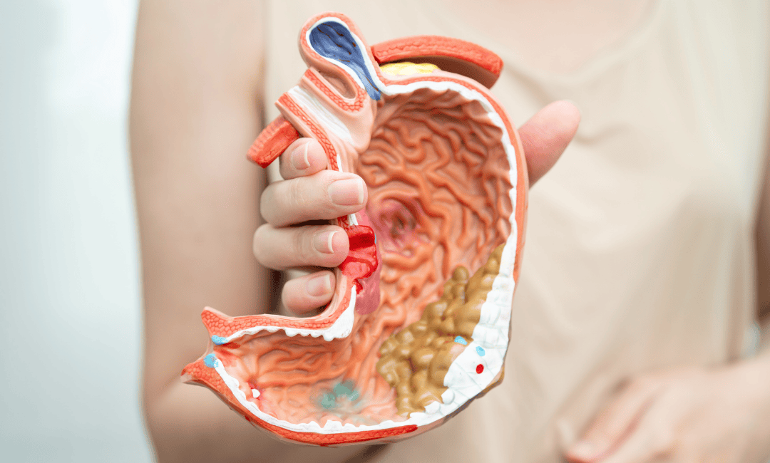  Lynch Syndrome