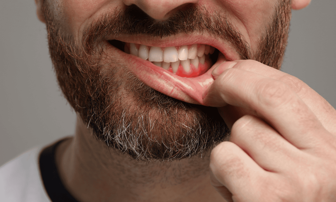 Bleeding gums or gingival haemorrhage