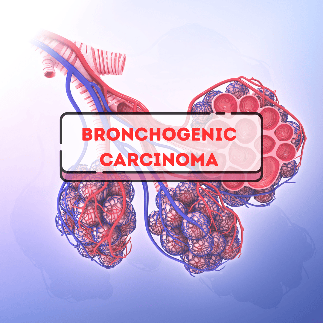 *Bronchogenic *Carcinoma: Symptoms, Treatment & Lung Cancer Facts image