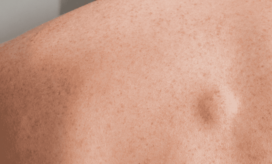 Symptoms of benign tumours