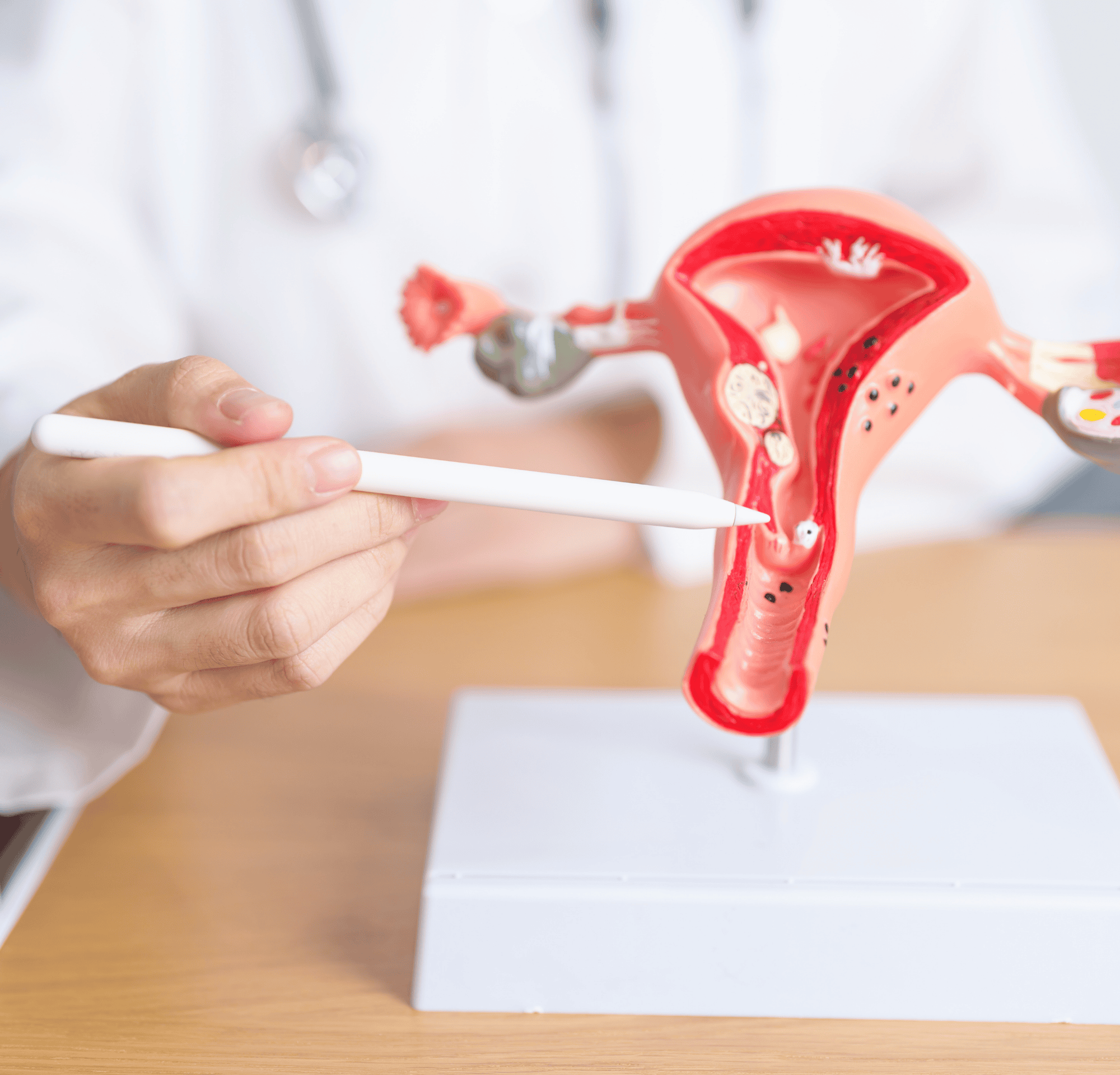 *Borderline *Ovarian *Tumour*: What You Need to Know Next image