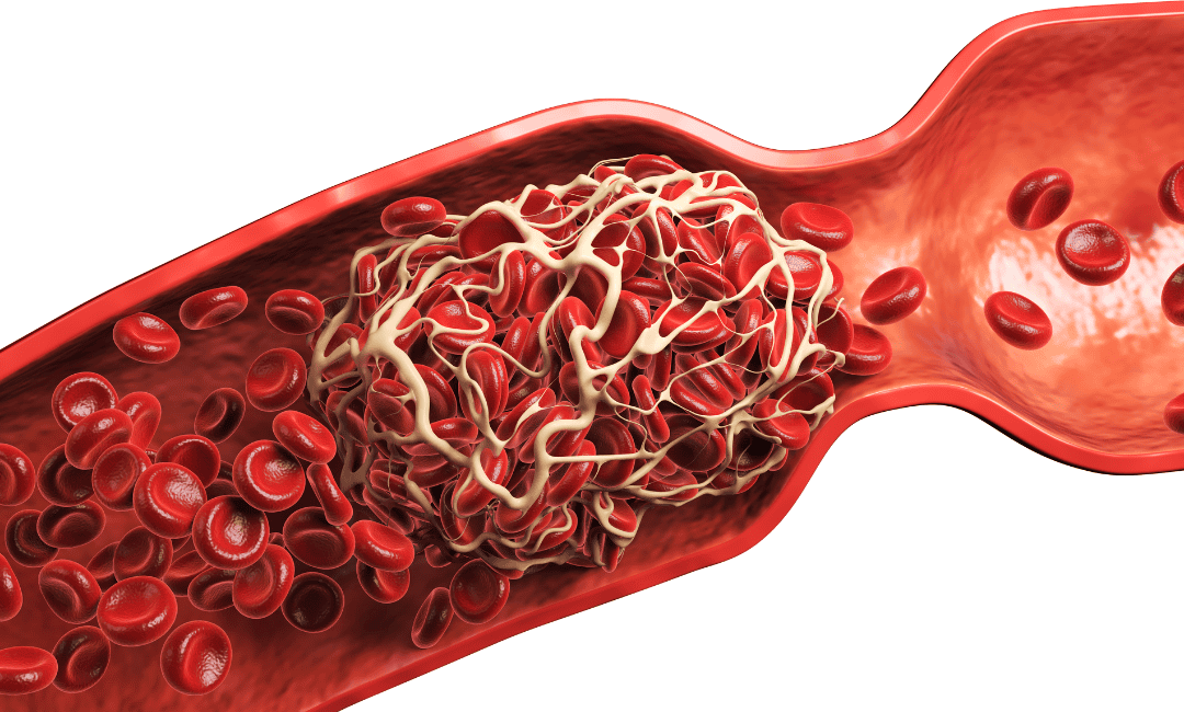 Myelofibrosis causes