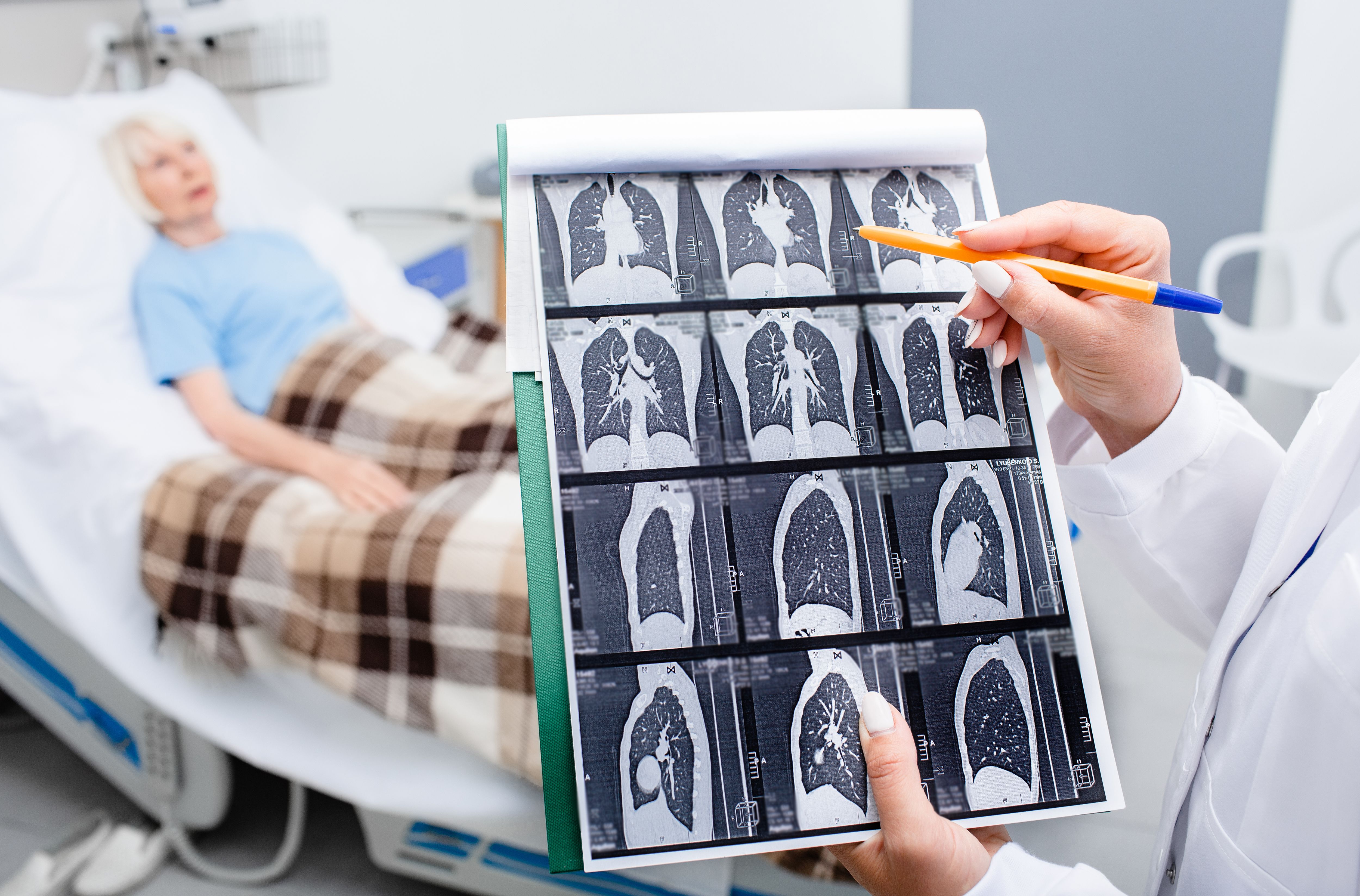 What Is the EGFR Mutation in Lung Cancer? image