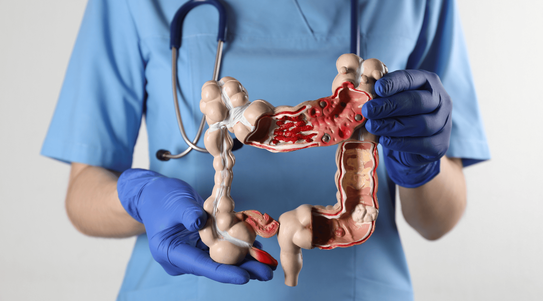 *Colon *Cancer *Treatment: Everything You Should Know image