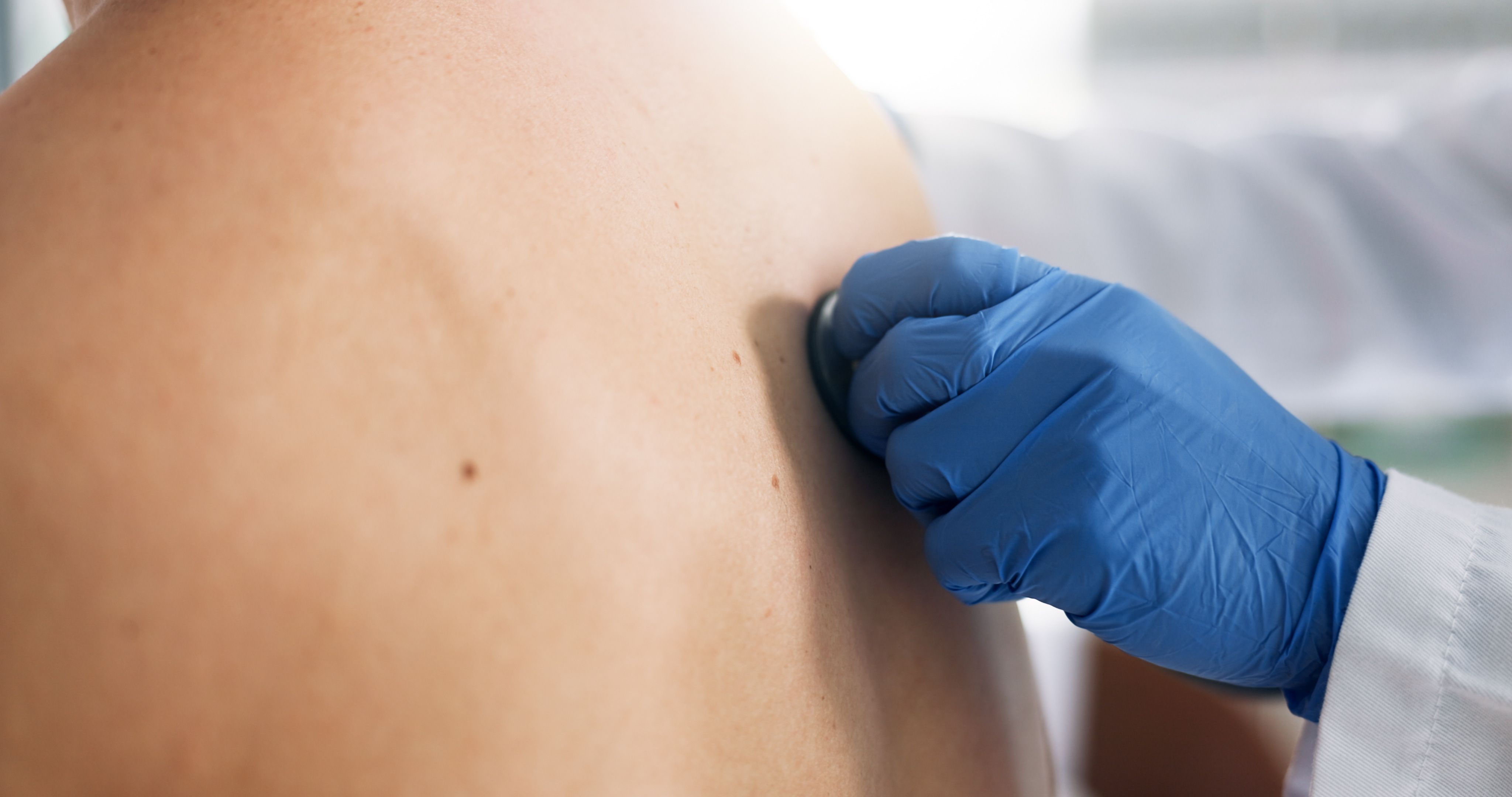 Skin Clues You Shouldn’t Ignore: Rare Lung Cancer Symptoms on Skin