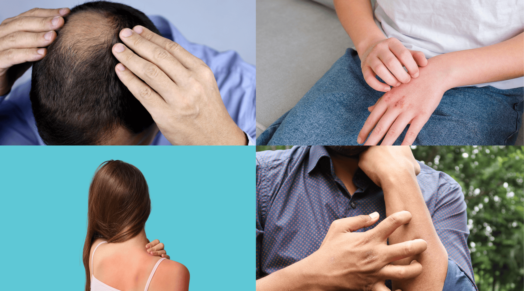 sezary symptoms